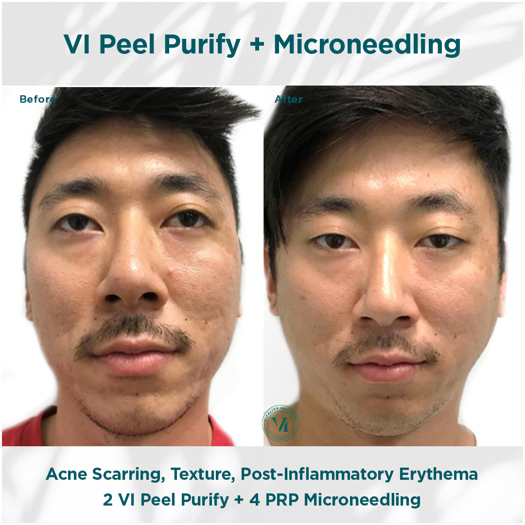 VI Peel Purify + Microneedling Before and After