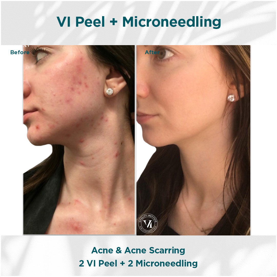 VI Peel + Microneedling Acne and Acne Scarring Before and After