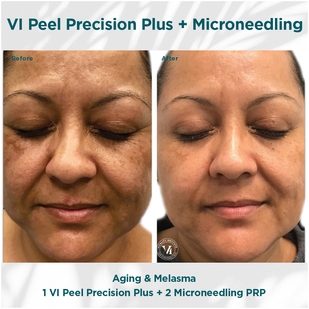 Aging and Melasma/1 VI Peel Precision Plus + 2 Microneedling Before and After