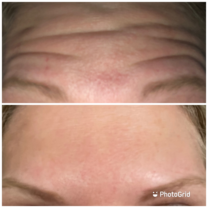 Before and after anti-wrinkle injections