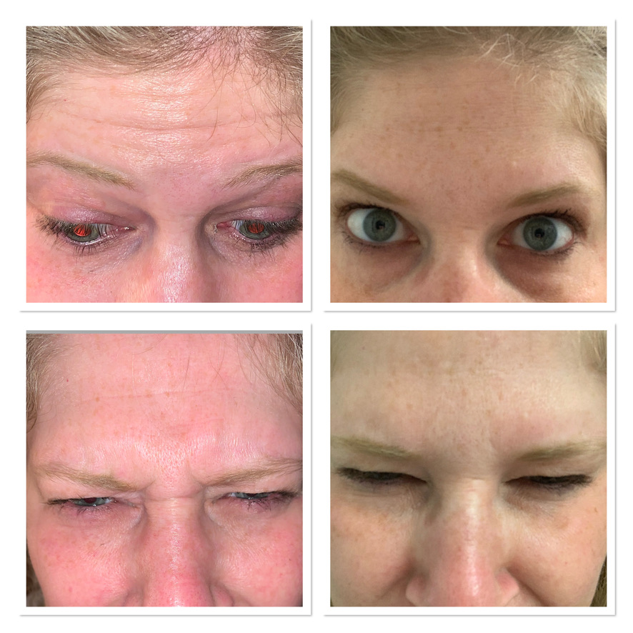 anti-wrinkle injections - before and after