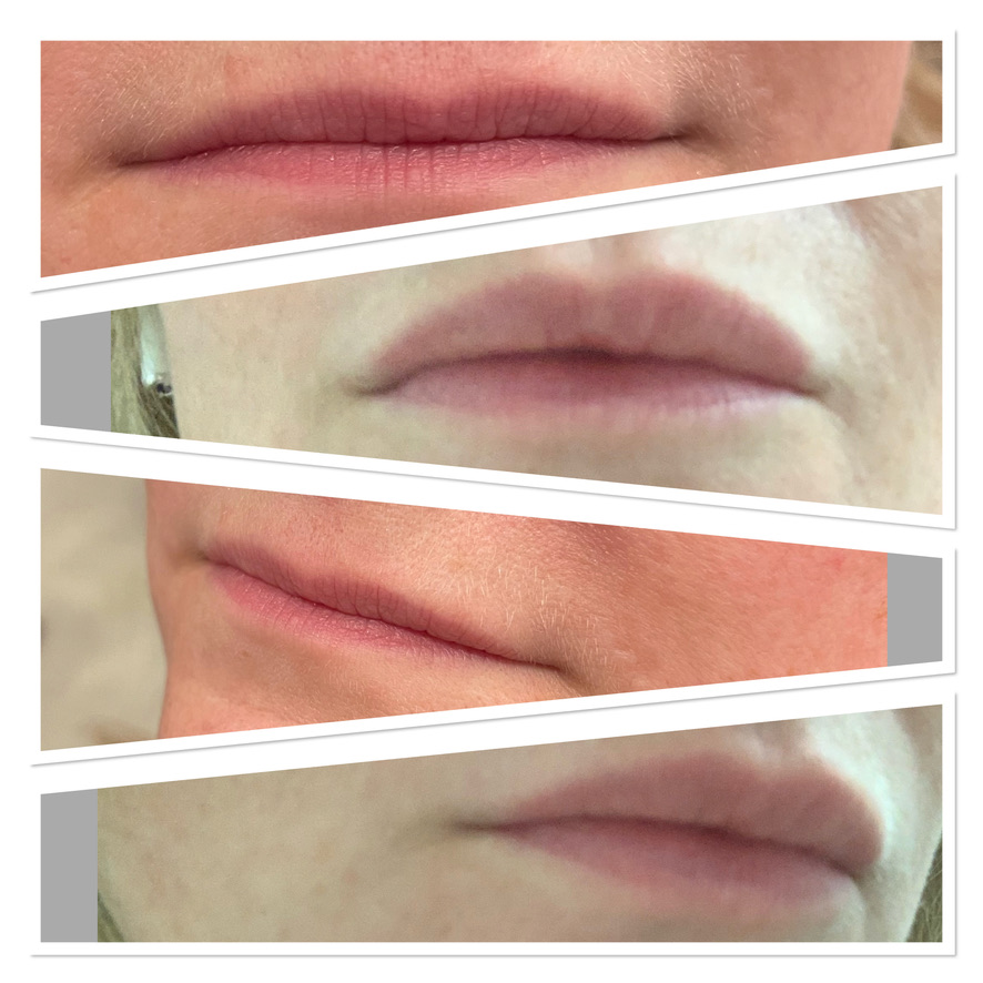 lip filler - before and after