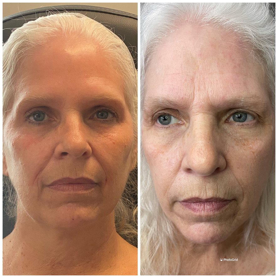 full face rejuvenation - before and after