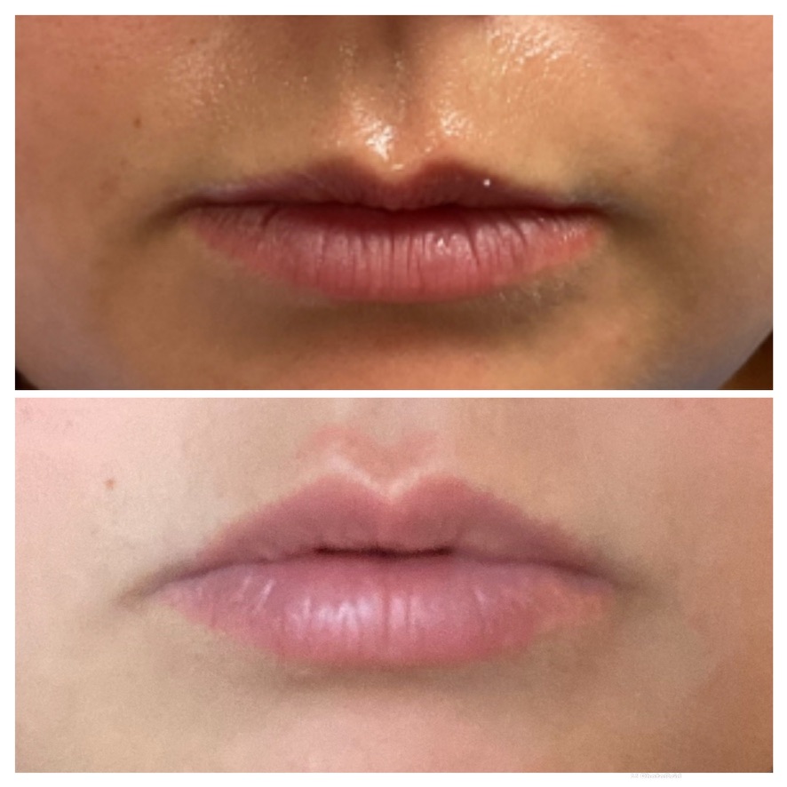 upper lip injections - before and after