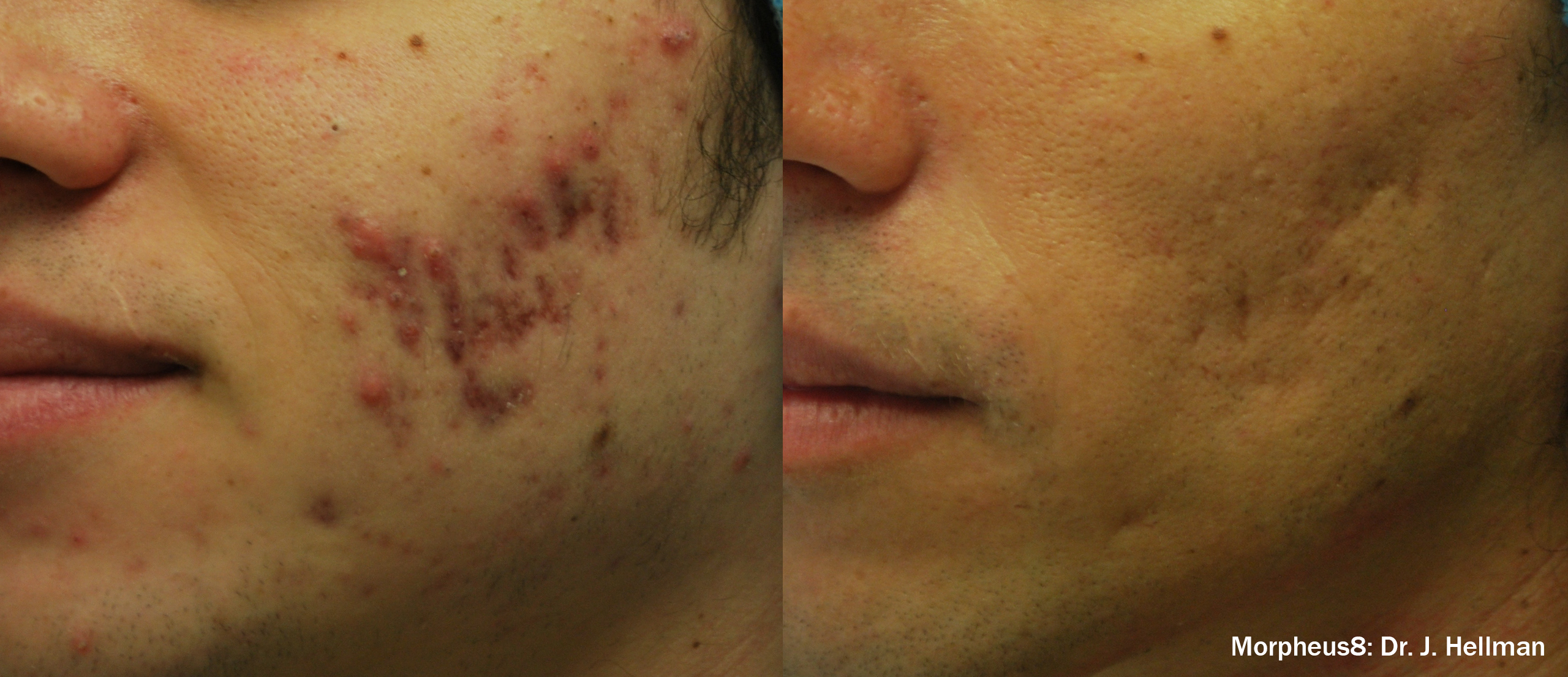Before/after acne scarring from Morpheus8