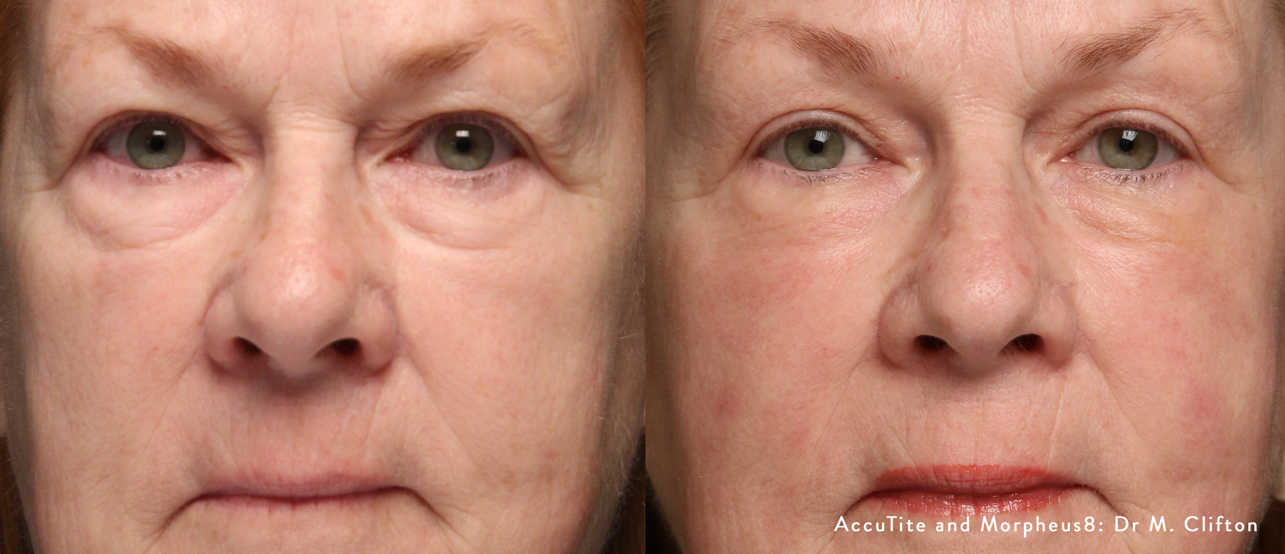 Before/after of fine lines and wrinkles from Morpheus8
