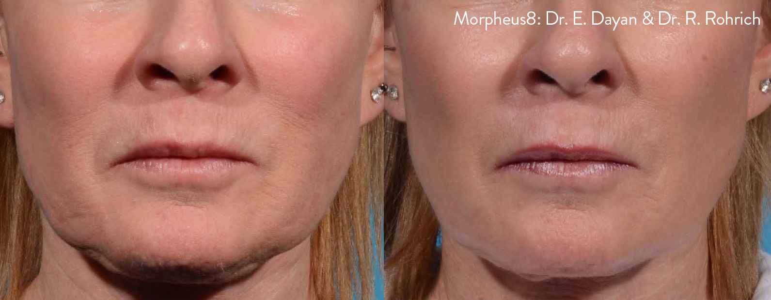 Before/after of tightened skin from Morpheus8