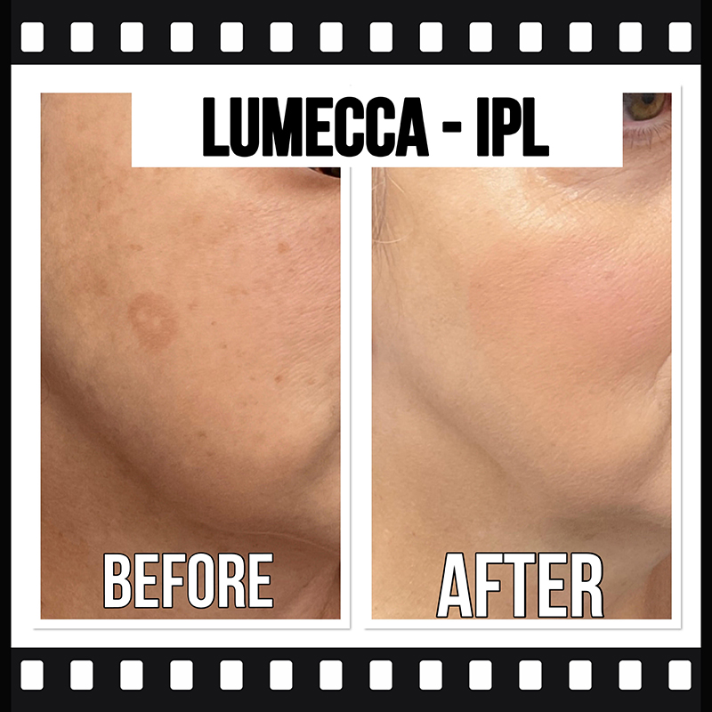 Lumecca IPL before/after